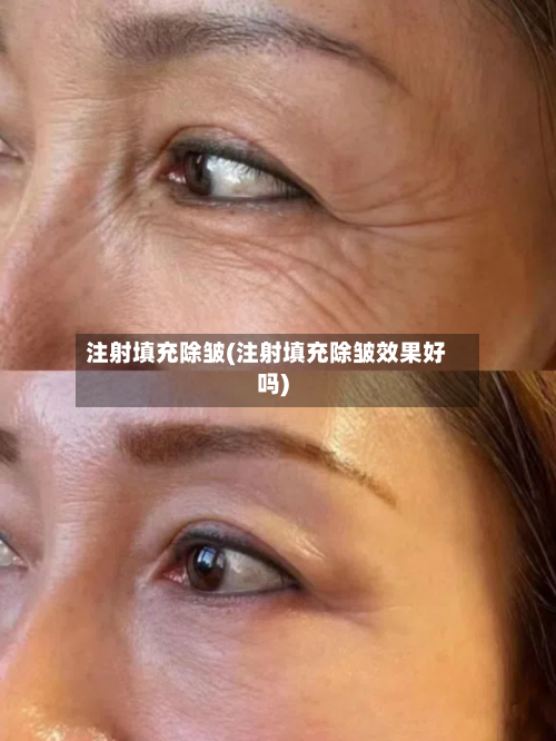 注射填充除皱(注射填充除皱效果好吗)
